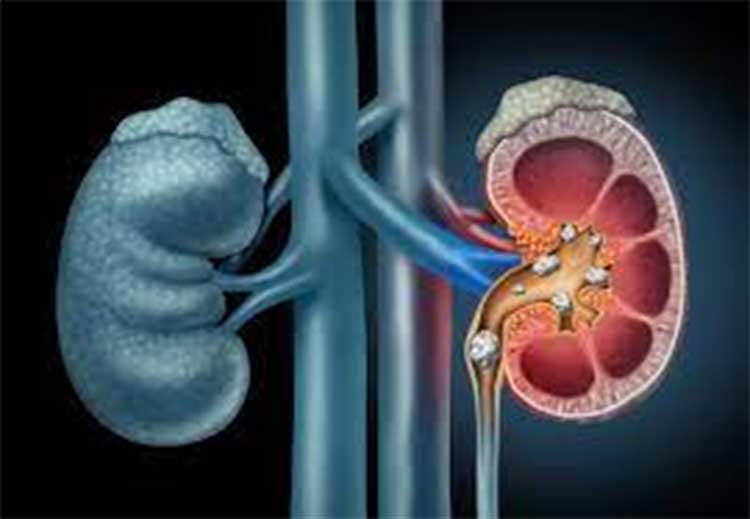 have kidney stones then follow these natural methods 