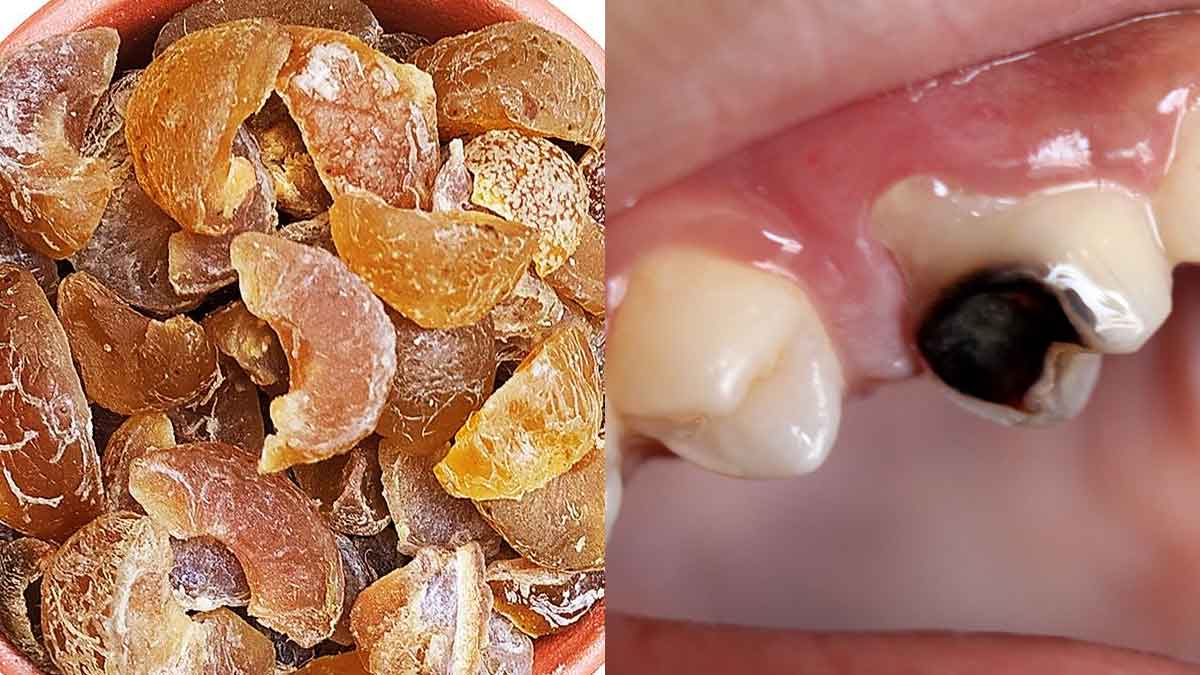 Dry Amla For Teeth : రోజూ ఈ చిన్న ముక్కను తినండి చాలు.. మీ దంతాలు పుచ్చిపోవు..! Dry Amla For Teeth take daily one piece to protect them